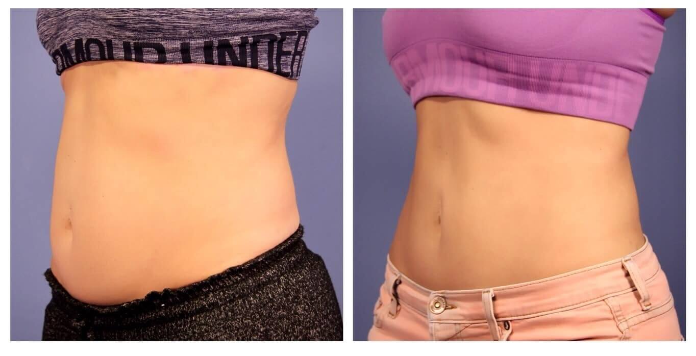 How Can I Find a Qualified Coolsculpting Provider?