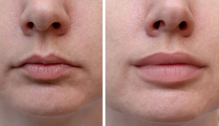 Tips for Maintaining Your Lip Filler Results